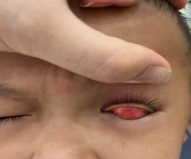 Bé trai 7 tuổi ở Thanh Hóa mắt “đỏ như hòn máu” sau khi ăn trứng gà có cả lòng trắng - 1