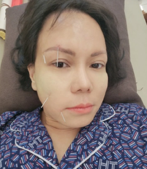 Nữ nghệ sĩ hài méo mặt phải chữa dài ngày, bác sĩ chỉ ra &#34;thủ phạm&#34; là việc rất nhiều người dễ mắc - 2