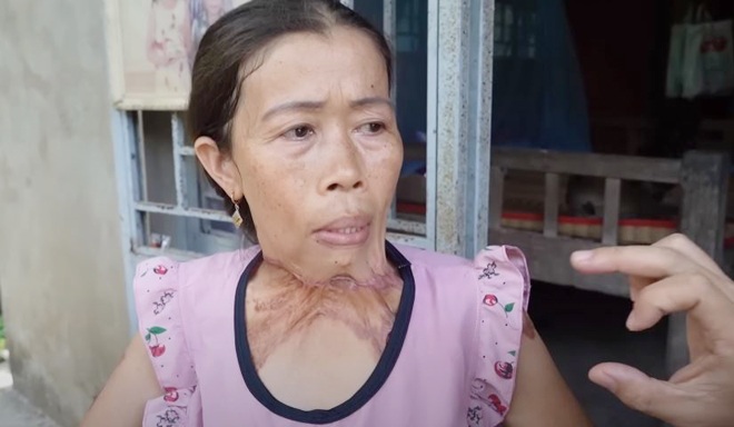 Người phụ nữ Tiền Giang mắc bệnh lạ, da thịt dính vào nhau khiến ai cũng xót thương - 1