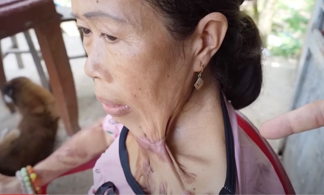 Người phụ nữ Tiền Giang mắc bệnh lạ, da thịt dính vào nhau khiến ai cũng xót thương - 2
