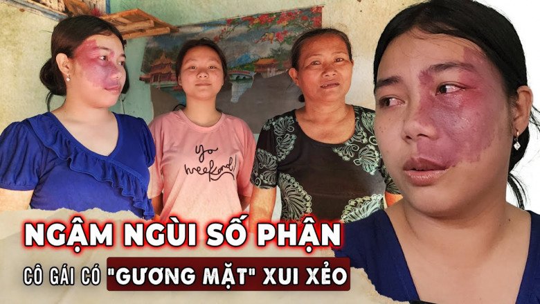 Cô gái 22 tuổi sở hữu gương mặt &#34;xui xẻo&#34; bị bạn bè xa lánh, không xin được việc làm và nỗi lòng người mẹ - 1