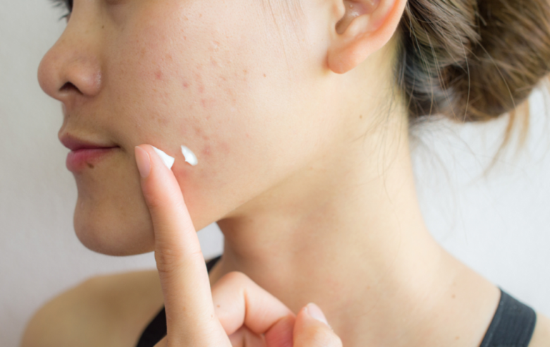 5 dấu hiệu &#34;cầu cứu&#34; của làn da khi dùng sai mỹ phẩm, chị em cần sửa ngay kẻo chưa già đã lão hóa - 1