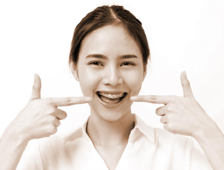 Niềng răng và lưu ý chăm sóc răng miệng