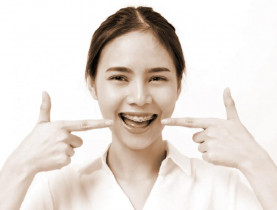 Niềng răng và lưu ý chăm sóc răng miệng