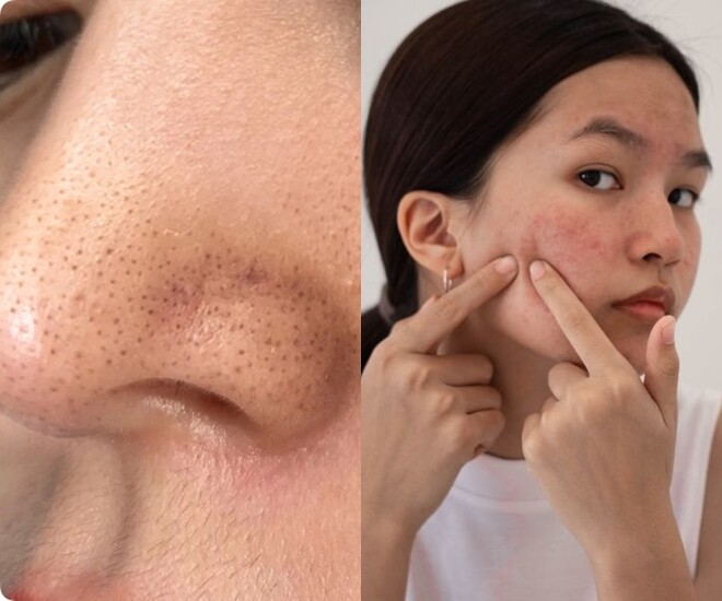 Muốn trị dứt điểm mụn đầu đen? Tránh xa 3 thực phẩm này nếu không muốn công sức skincare đổ sông đổ biển - 1