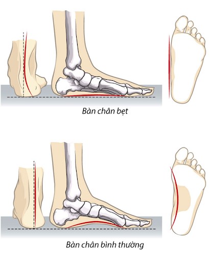 4 kiểu giày dép đẹp nhưng &#34;độc&#34;, có cho tiền cũng không nên mua kẻo hỏng vóc dáng lẫn rước loạt hậu họa - 9