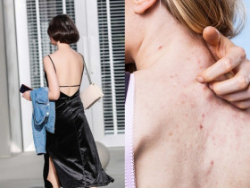 5 thói quen tưởng vô hại khiến mụn lưng mọc dày, trị mãi không hết, chỉ thay đổi 1 bước khi gội đầu có thể cải thiện rất nhiều
