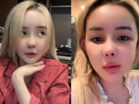 Hội gái xinh phải nếm "trái đắng" vì sửa mũi: Hơn 10 lần vẫn chưa đẹp, có người biến chứng nặng sau 12 năm
