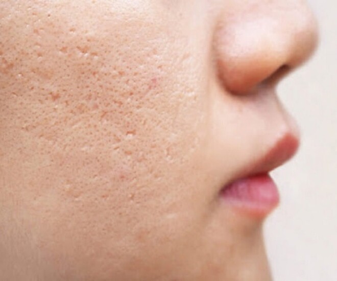 5 bước làm đẹp từ trong ra ngoài giúp xóa mờ lỗ chân lông to, tạm biệt khuôn mặt bóng loáng dầu - 1