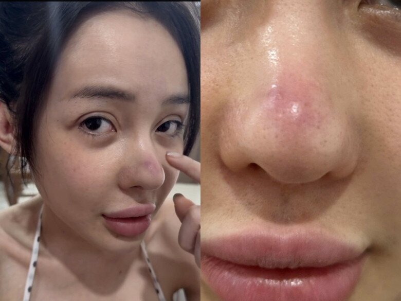 Sau 12 lần phẫu thuật thẩm mỹ rồi bị co rút mũi, Ngân 98 lại tiếp tục &#34;gặp biến&#34; khiến dân tình tá hoả - 2