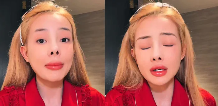 Sau 12 lần phẫu thuật thẩm mỹ rồi bị co rút mũi, Ngân 98 lại tiếp tục &#34;gặp biến&#34; khiến dân tình tá hoả - 6