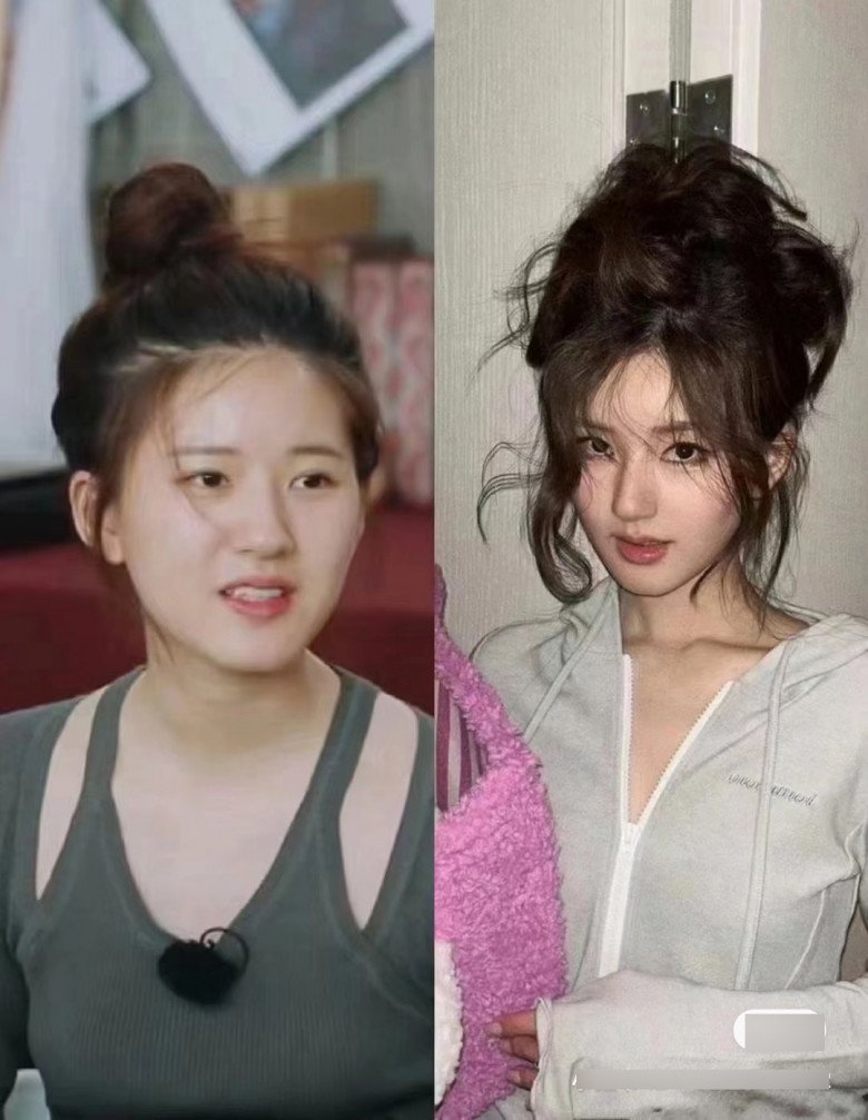 Rộ lên phương pháp phẫu thuật thẩm mỹ &#34;0&#34; đồng, chẳng đau đớn mà gọn mặt thần kỳ - 2