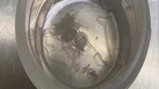 Đang dụi mắt bất ngờ thấy vật lạ rơi ra, người phụ nữ sợ hãi vội vào viện, phát hiện ra thứ kinh dị - 2