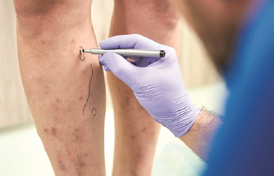 Suy tĩnh mạch chi dưới - 1