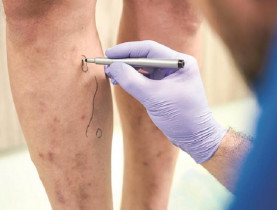 Suy tĩnh mạch chi dưới