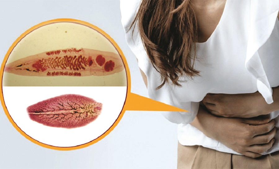 Nhiễm sán lá gan nặng vì thói quen ăn đồ tái, sống - 1