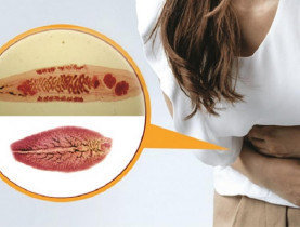 Nhiễm sán lá gan nặng vì thói quen ăn đồ tái, sống