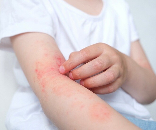 Đi khám viêm da chàng trai phát hiện mắc căn bệnh nghe tên đã sợ, người trẻ cần hết sức chú ý - 1