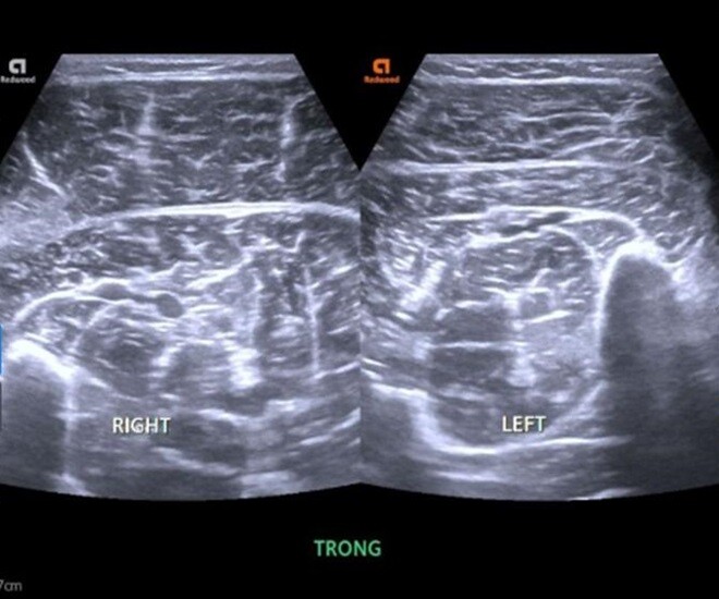 Tưởng nhẹ khi mắc cúm A, nam sinh 16 tuổi bị biến chứng hiếm gặp có thể gây suy thận cấp - 1
